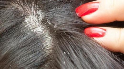 تفسير حلم القمل في المنام